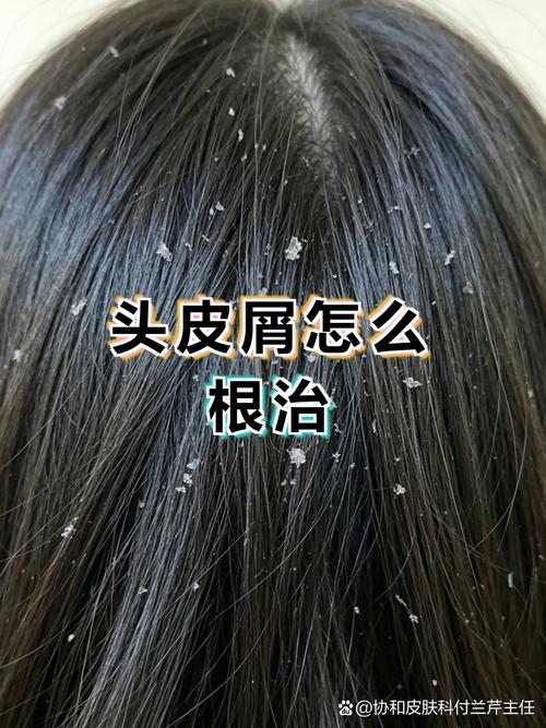 头皮屑根治需先明确类型,再针对性调整护理习惯与